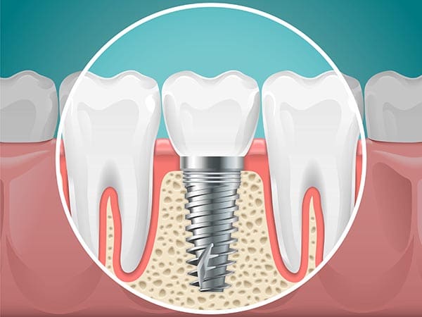 Dental Implant placement in Wilmington NC