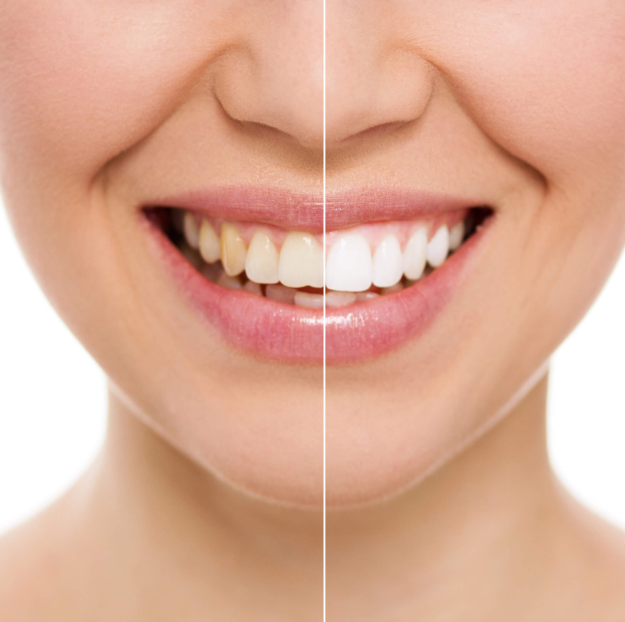 before and after cosmetic dentistry wilmington nc
