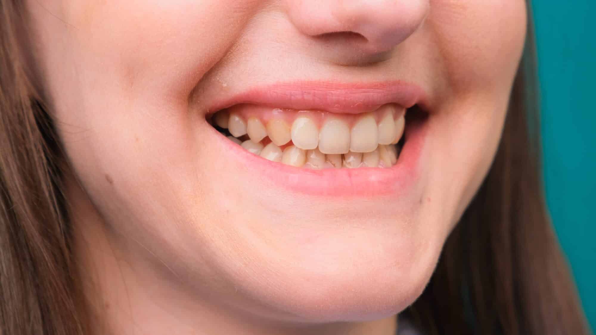 smoker's stained teeth needs cosmetic dentistry wilmington nc