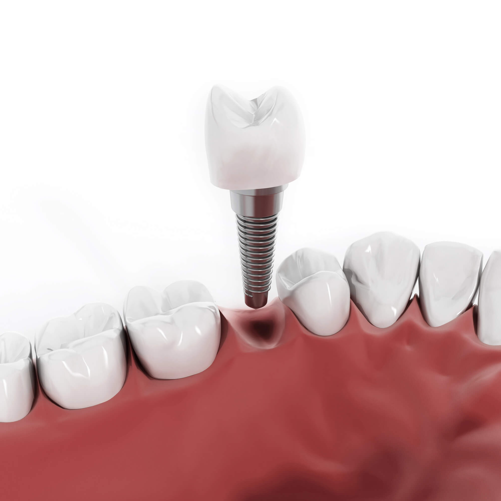 dental-implants-wilmington