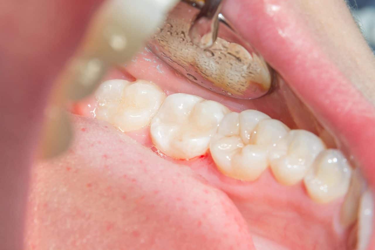 To Fill or Not to Fill How to Know When You Need a Dental Filling